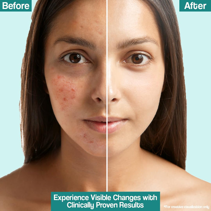 Venusia Acne Control Moisturizer 75g